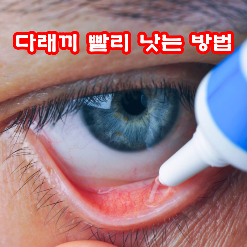 다래끼 빨리 낫는 방법