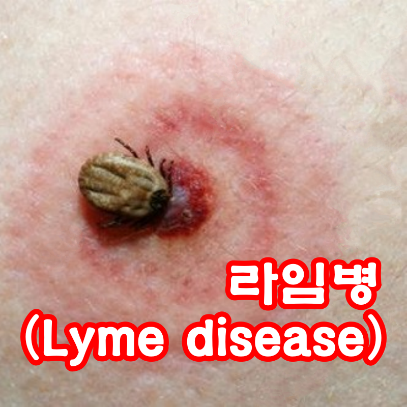 라임병(Lyme disease) 진드기